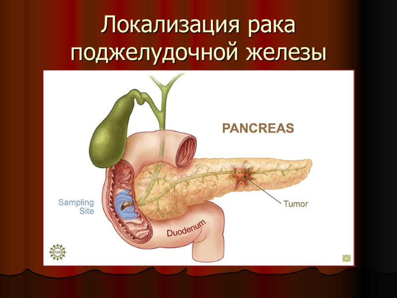 Локализация рака поджелудочной железы